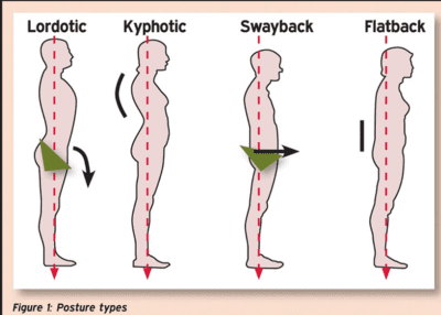 different posture types and what they look like sway back, flat back, lordosis
